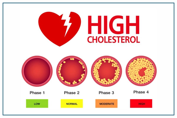 high-cholesterol-overview.jpg