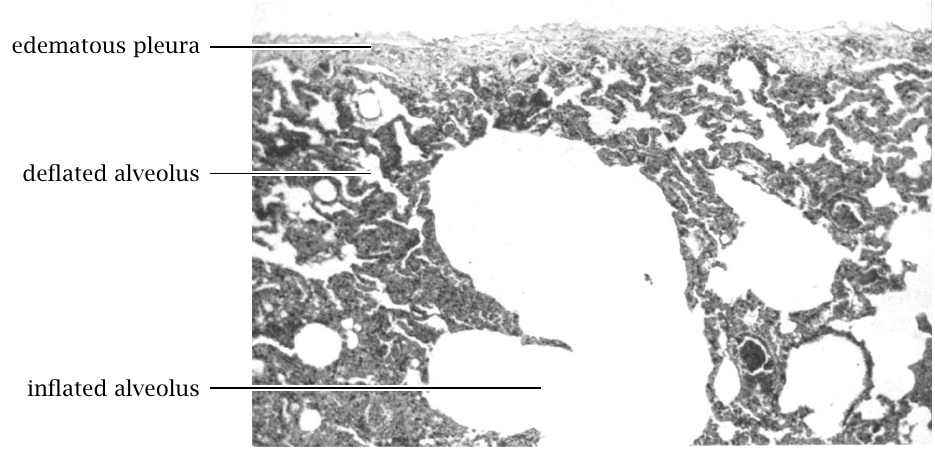 emphysema-pic.jpg